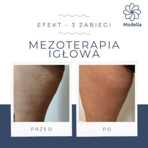 Leczenie igłowe mezoterapią Łódź