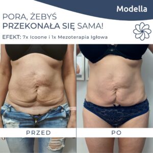 Mezoterapia z użyciem igieł Łódź