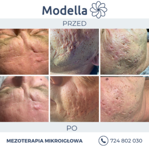 Mezoterapia microneedling Łódź