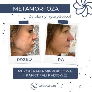 Leczenie mikroigłową mezoterapią Łódź